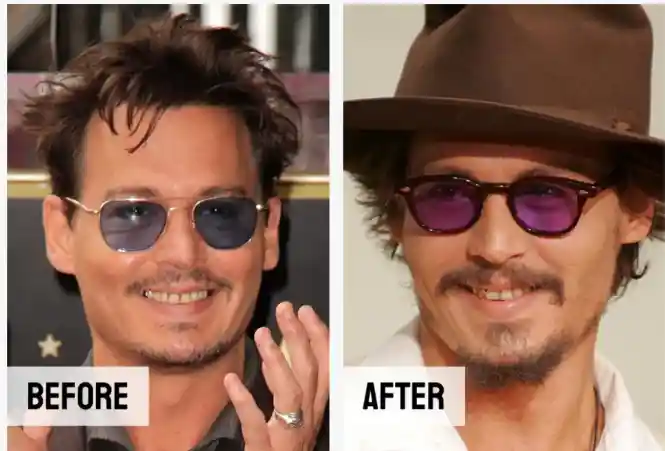 Johnny Depp Teeth Before And After